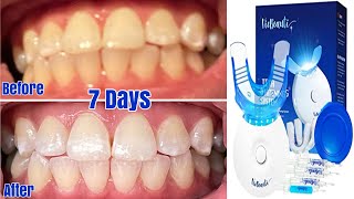 VieBeauti Teeth Whitening System Unboxing Review 7 Days Later [upl. by Ydoc]