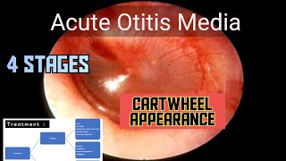 Acute Otitis Media Etiology  Signs  Stages  Treatment  ENT  MEDU [upl. by Illehs666]