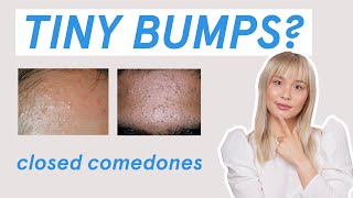 Why those tiny bumps AREN’T fungal acne [upl. by Padgett]