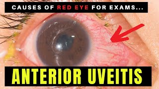 Causes of Red Eye  Part 2 ANTERIOR UVEITIS Iritis [upl. by Ahsiekin434]