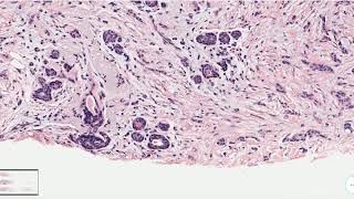 Tubulolobular Carcinoma Breast  Histopathology [upl. by Ocire]