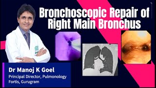 Bronchoscopic Dilatation Bronchial Stenosis Dr MANOJ GOEL lungcancer tuberculosis bronchoscopy [upl. by Sinned]