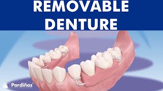 Removable partial denture © [upl. by Denton]