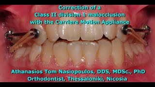 Class II Correction with the Carriere  Athanasios Tom Nasiopoulos [upl. by Serrano]