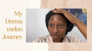 My Dermamelan Journey USING MESOESTETIC DERMAMELAN ON DARK SKIN  chemical peel [upl. by Thema]