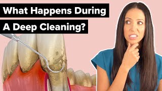 What Happens During a Deep Cleaning Procedure Scaling and Root Planing [upl. by Ilsa]