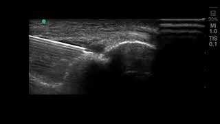 Elbow Ultrasound Intra Articular Injection using the Posterior Approach [upl. by Tayib]