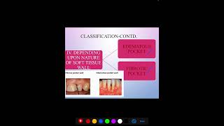 PERIODONTAL POCKET [upl. by Marvel]