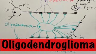 Oligodendroglioma [upl. by Aselehc827]