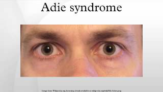 Adie syndrome [upl. by Fasano864]