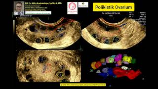 Ovarium Polikistik [upl. by Furiya]