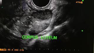 Corpus luteum with peripheral ring of fire USG U ltrasound [upl. by Ardnikal]