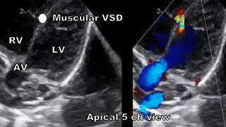 Types of VSD echocardiography [upl. by Russo]