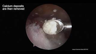 Arthroscopic removal calcific tendonitis [upl. by Collayer]