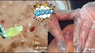 Ultimate Satisfying Acne Removal Compilation Best Pimple Pops Blackheads and Cysts [upl. by Grider]