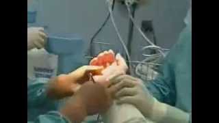 Carpal Tunnel Syndrome  Endoscopic Release Surgery carpal tunnel surgery [upl. by Euton661]