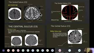 Supratentorial anatomy [upl. by Nomaid495]