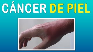 CANCER DE PIEL [upl. by Nnoved695]