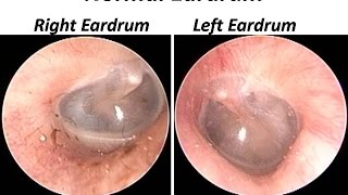 The Normal Eardrum  Otoendoscopy view [upl. by Perrine]