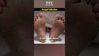 What is Fungal Infection amp Its Treatment  DTC Skin Clinic [upl. by Nahtanhoj565]