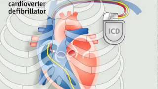 How pacemakers work [upl. by Dnama]