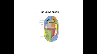 Nasopalatine Nerve Block Injection [upl. by Hploda370]