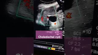 choledochal cystliverporta hepatisabdominal ultrasound [upl. by Altaf]