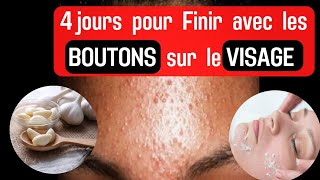 COMMENT ELIMINER LES BOUTONS SUR LE VISAGE [upl. by Adnowat]