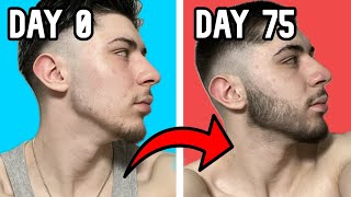 Minoxidil Beard Growth Week 11 [upl. by Kohler916]