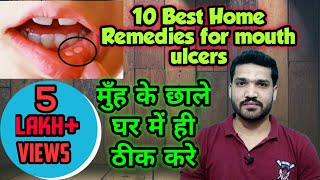 मुँह के छालों के 10 घरेलु इलाज । How to treat mouth ulcers at home [upl. by Ymorej767]