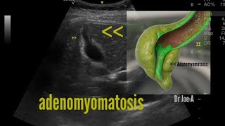 Fundal segmental adenomyomatosis of gallbladder ultrasound and color Doppler video [upl. by Sandro]