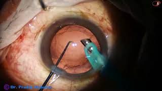 Double Rhexis Submarine Chop Epinucleus to protect P C in an Intumescent cataract Pradip Mohanta [upl. by Adkins]