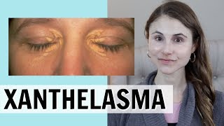 XANTHELASMA WHAT IT IS amp HOW IT IS TREATED DR DRAY [upl. by Cirre]