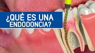 Cómo es una endodoncia matar el nervio dental  Odontoespecialistas [upl. by Ecneralc]