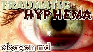 Cleavon MD  Traumatic Hyphema [upl. by Notyad]