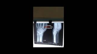 wrist non specific synovitis [upl. by Oir]