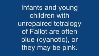 Tetralogy of fallot TOF [upl. by Eelan]