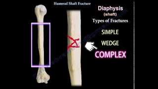 Humeral Shaft Fracture  Everything You Need To Know  Dr Nabil Ebraheim [upl. by Berghoff]