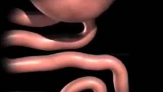 gastric bypass animation [upl. by Ahseuqal]