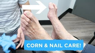 Apical Heloma Durum Treatment  Corn and Nail Care [upl. by Akirdnas]