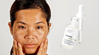 How To Use The Ordinary Alpha Arbutin 2  HA for Hyperpigmentation [upl. by Llewsor]