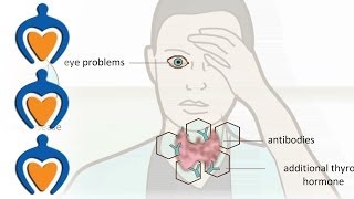 Thyroid problems  most common thyroid problems symptoms and treatment [upl. by Darra]