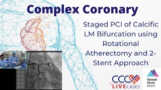 Staged PCI of Calcific LM Bifurcation using Rotational Atherectomy amp 2Stent Tech March 2016 Video [upl. by Gherardi564]