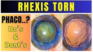 Rhexis is torn Dos and Donts for Phacoemulsification Principles to Follow [upl. by Coy]