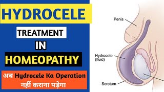 Hydrocele Treatment  Home Remedies For Hydrocele  Dr Saad Ahmed [upl. by Iruam]