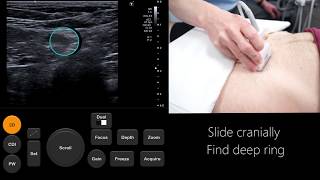 Ultrasound Tutorial InguinalFemoral Hernia Assessment  Radiology Nation [upl. by Olyhs]