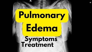 Pulmonary edema symptoms treatment in Hindi  lungs me Pani bharne se kya hota hai [upl. by Phila]