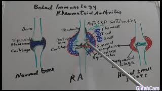 Pathophysiology of Rheumatoid arthritis [upl. by Ibed]