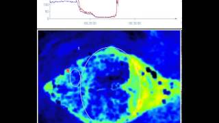 Cardiac Arrest  Perfusion Measurement in Brain [upl. by Darelle896]