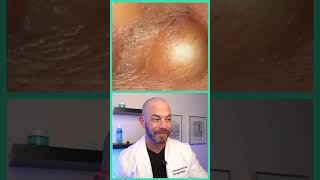 Doctor reacts to juicy cyst pop dermreacts doctorreacts pimplepop [upl. by Sperry]